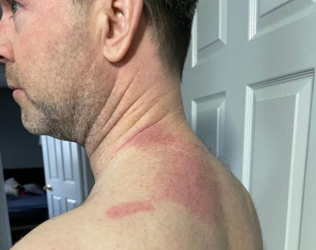 A man shows a red rash on his neck and back.