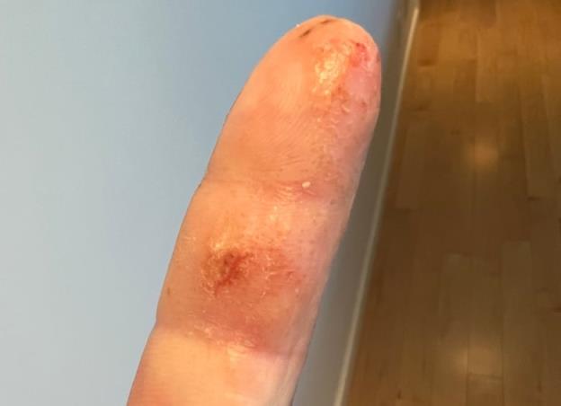 A man's finger with painful-looking blisters.